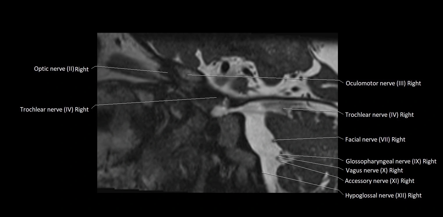 Cranial nerve sagittal anatomy MRI 3T image 42.webp